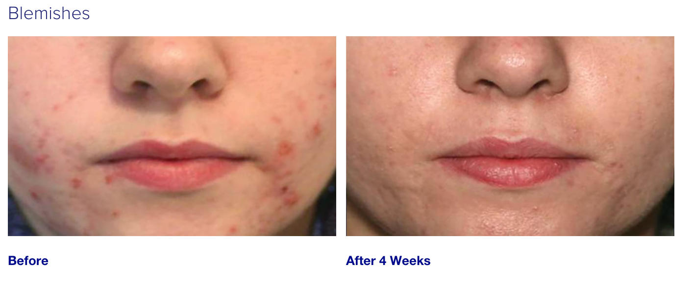iS Clinical Active Serum