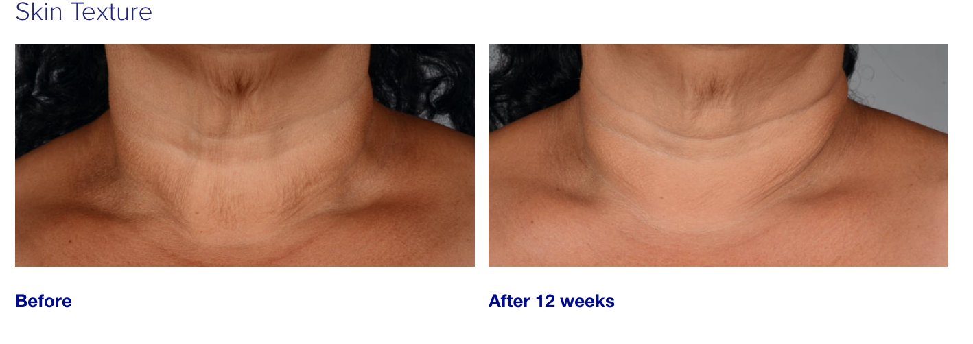 iS Clinical NeckPerfect Complex