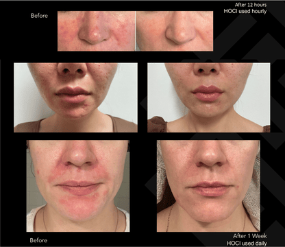 Hale Derma Hypochlorous Acid Spray