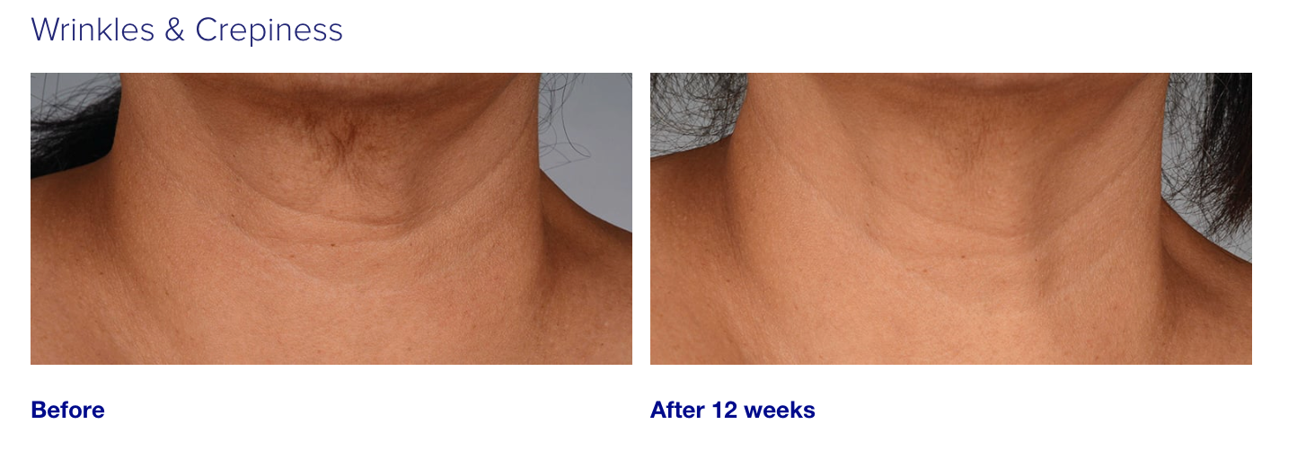 iS Clinical NeckPerfect Complex