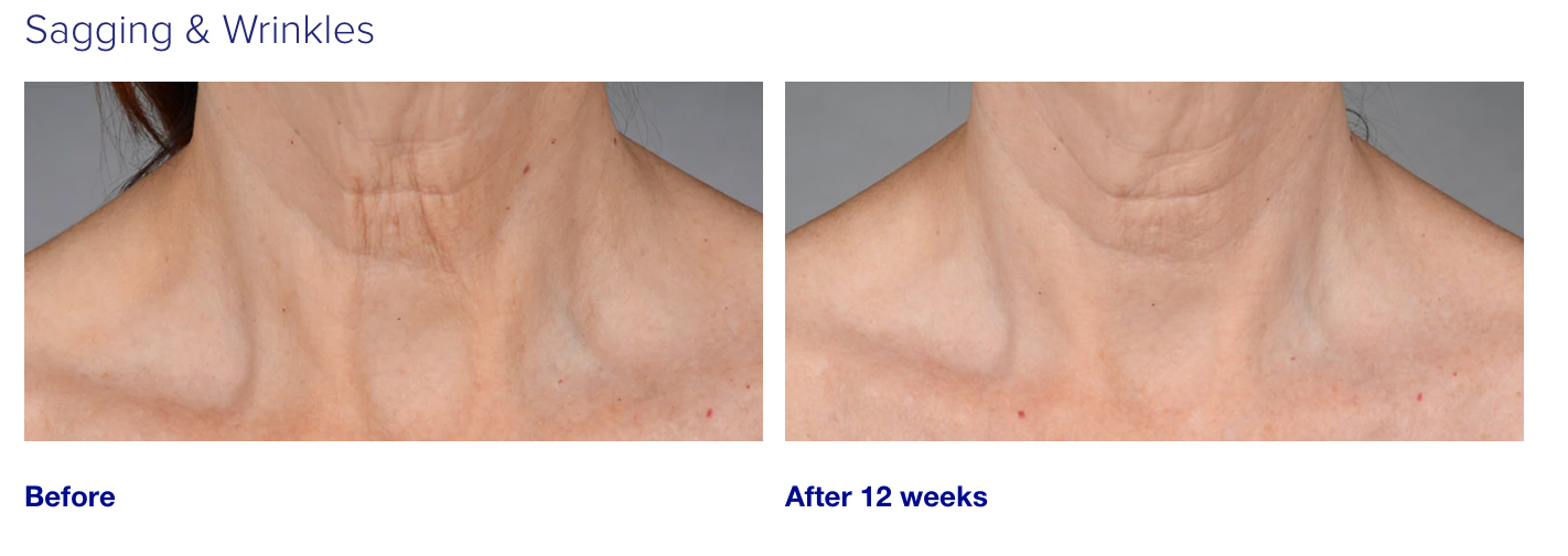 iS Clinical NeckPerfect Complex